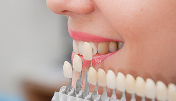 dec17_veneers veneers