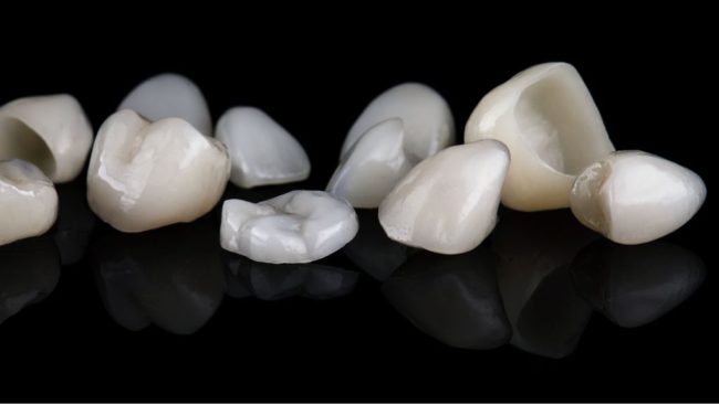 Dental Venteers0