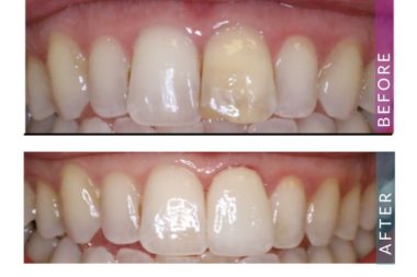 Porcelain Crown – Patient Picture Porcelain Crown - Patient Picture