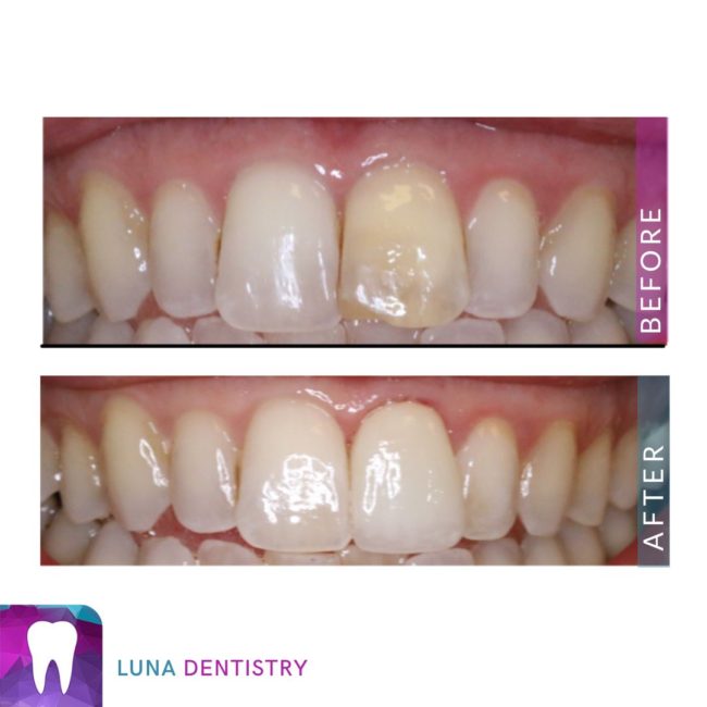 Porcelain Crown – Patient Picture Porcelain Crown - Patient Picture