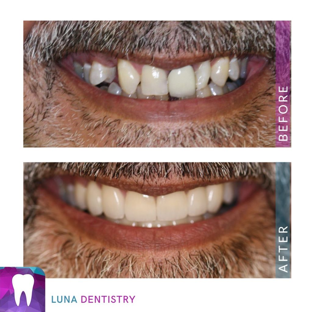 Porcelain Crowns - Patient Picture