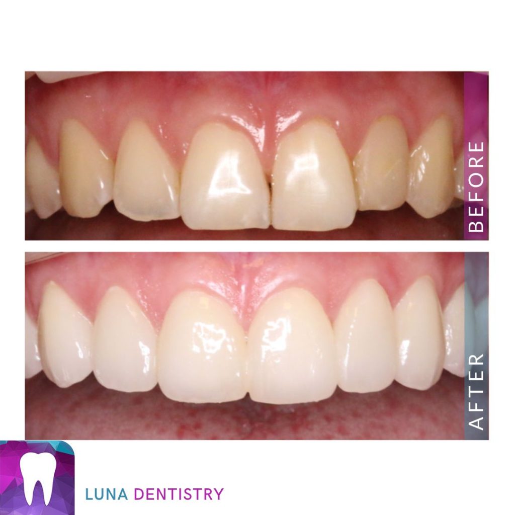 Porcelain Veneer - Patient Picture
