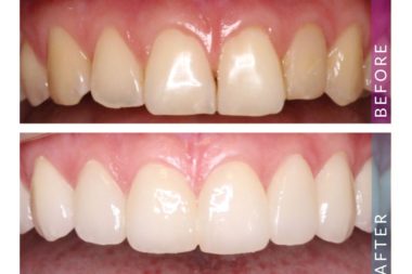 Porcelain Veneer – Patient Picture Porcelain Veneer - Patient Picture