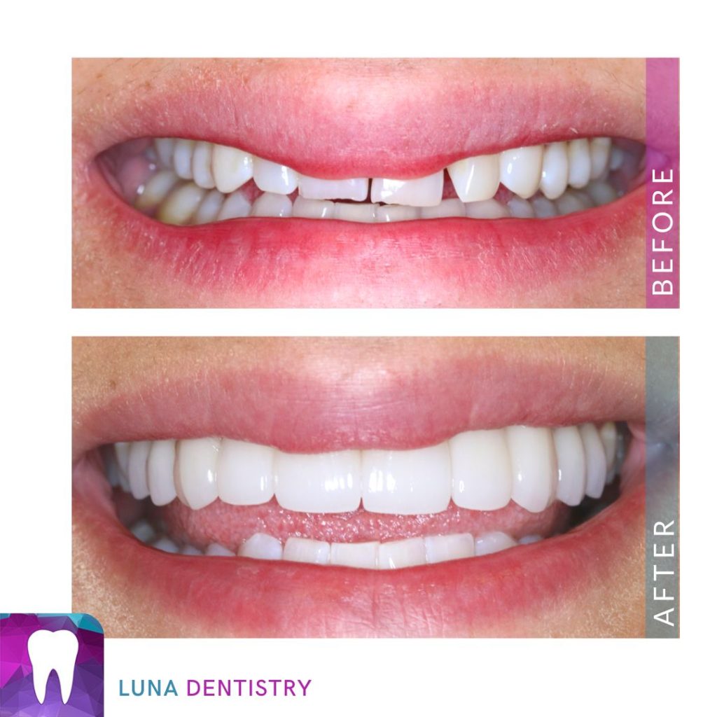 10 Porcelain Veneer Case Study