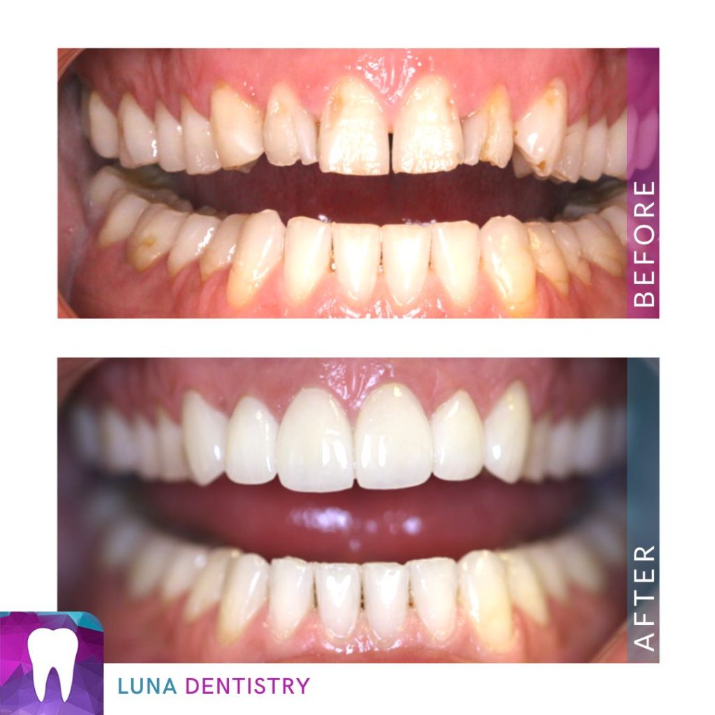 Porcelain Veneers Case Study