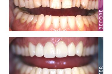 Porcelain Veneers Case Study Porcelain Veneers Case Study
