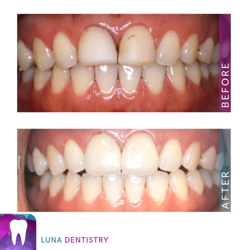 Two minimally prepped porcelain veneers case study