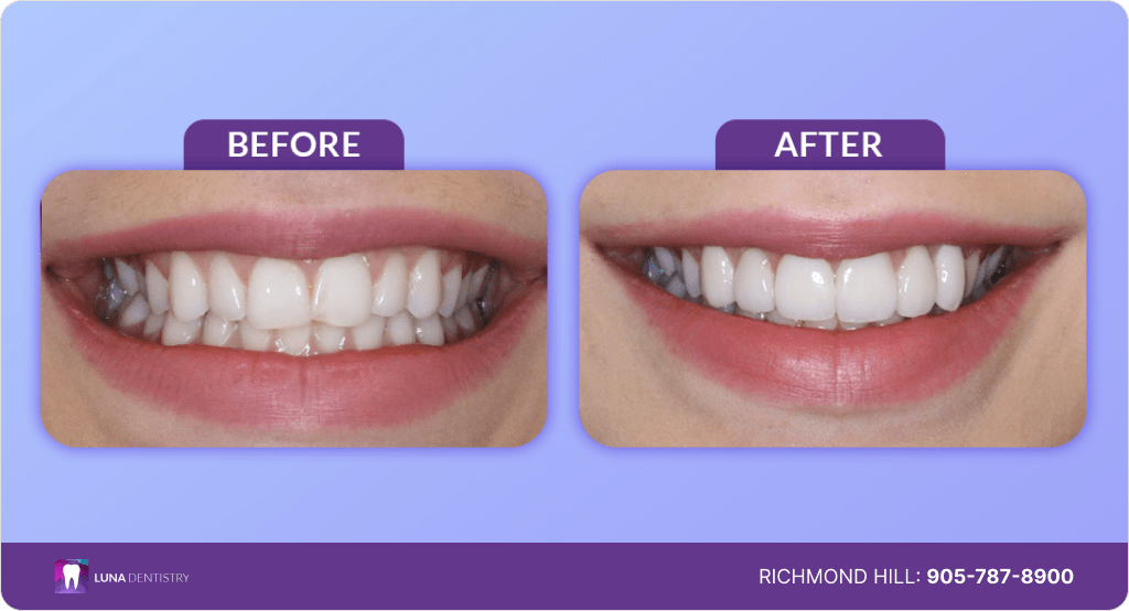 Best Cosmetic Dentistry - Luna - Before After
