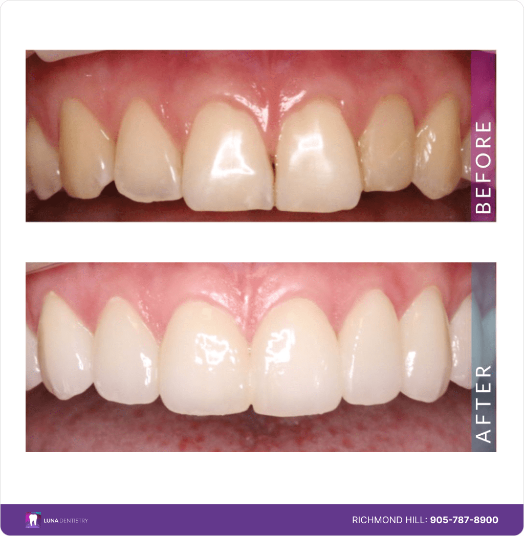 8 Porcelain Veneers Case Study-min