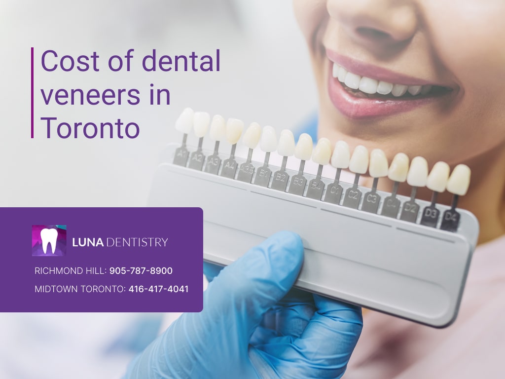 Cost of dental veneers in Toronto Cost of dental veneers in Toronto