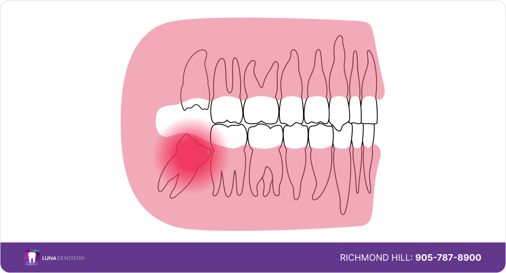 How Much Does it Cost To Remove Wisdom Teeth