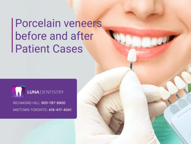 Porcelain veneers before and after Patient Cases 1 Porcelain veneers before and after Patient Cases 1