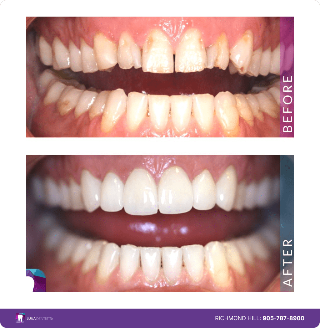Restored 6 Upper Teeth Porcelain Veneers-min