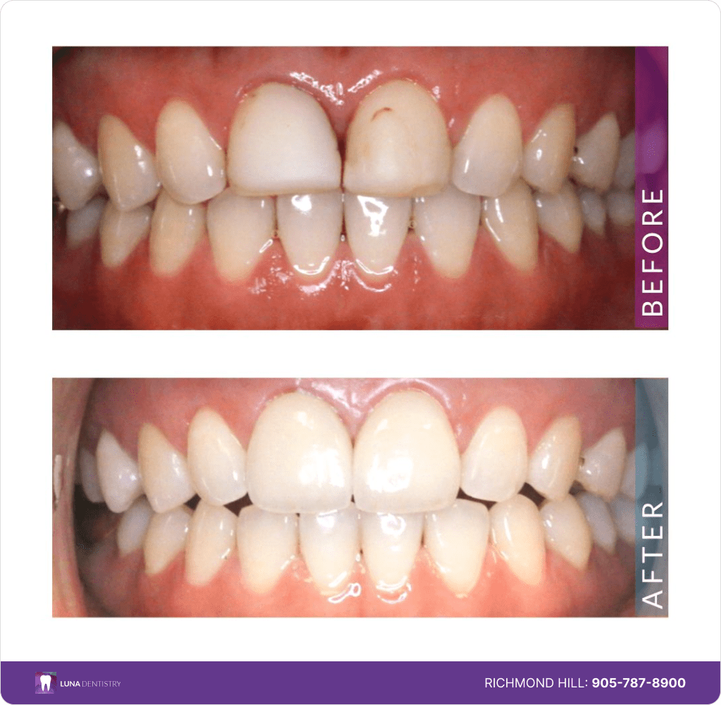 Two minimally prepped porcelain veneers-min